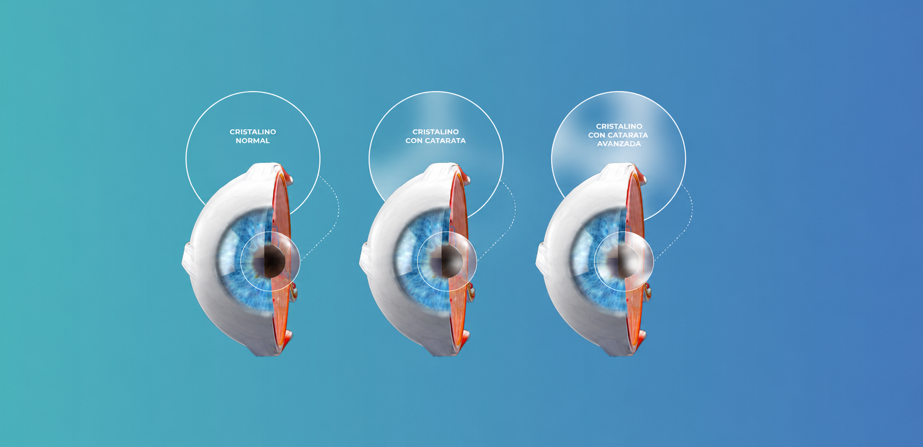Comparison between a normal lens, a lens with a cataract, and a lens with an advanced cataract