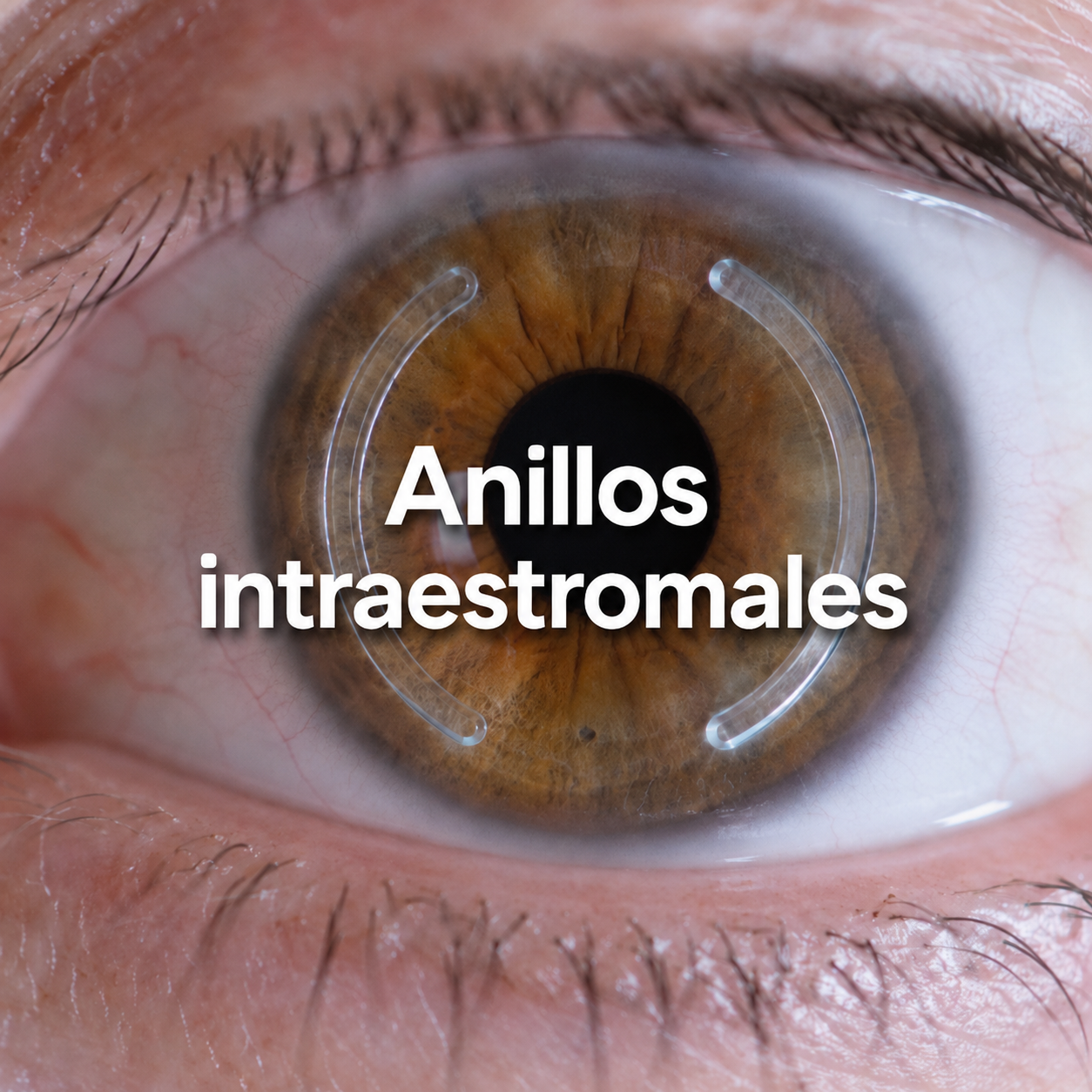 Anillos Intraestromales