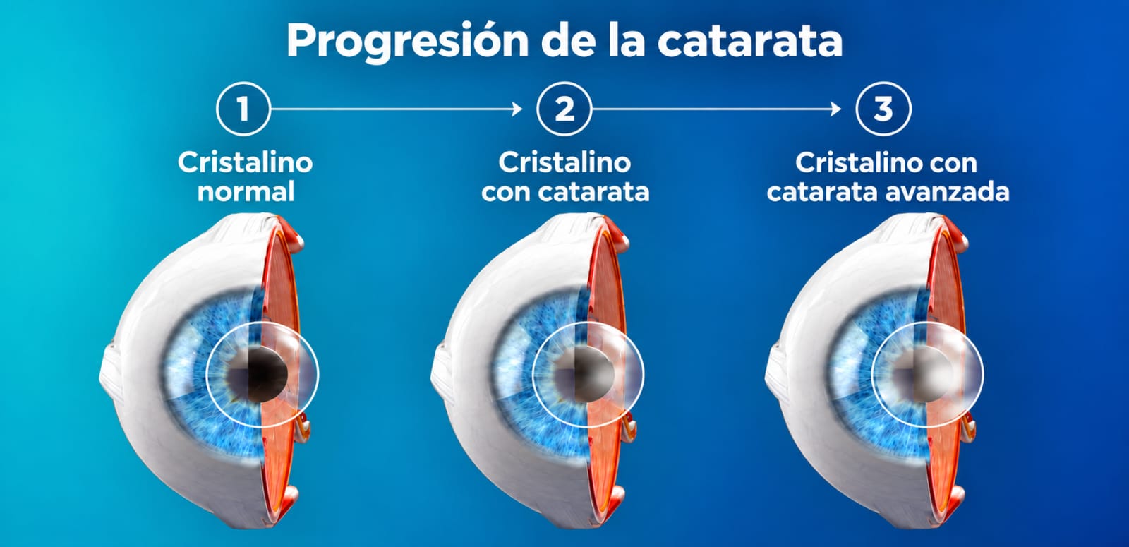 Progresión de la catarata: cristalino normal, con catarata y con catarata avanzada